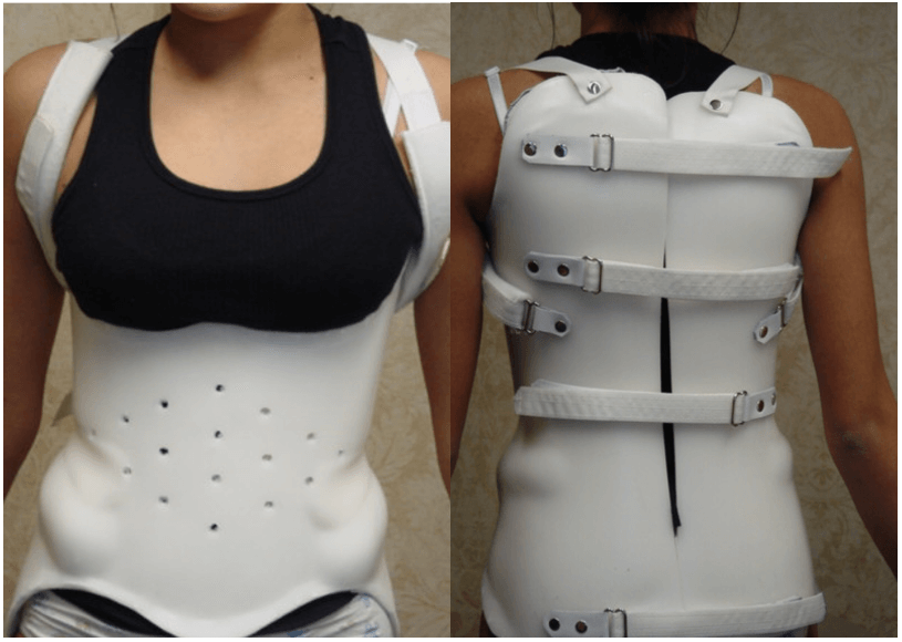 Scoliosis Bracing NYC, Rigo Cheneau brace